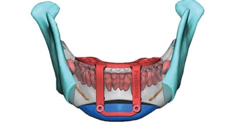 3D Systems Launches New VSP Hybrid Maxillofacial Surgical Guides Hiswai