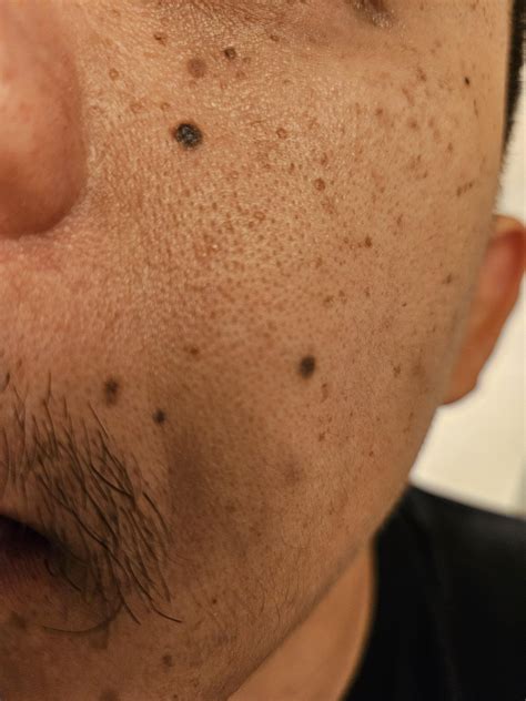 How Can I Get Rid Of These Bumps And Dark Spots Ive Gotten As I Aged