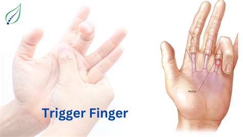 Trigger Finger: Causes, Symptoms, and Treatment Options | Best Back Pain, Slip Disc, Knee ...