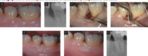 Minimally Invasive Surgical Techniques In Periodontal Regeneration