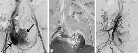 Arteriovenous Malformation Associated With Intravenous Leiomyomatosis