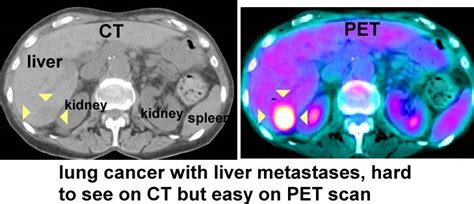 Ct Vs Pet Scan For Cancer Cancerwalls