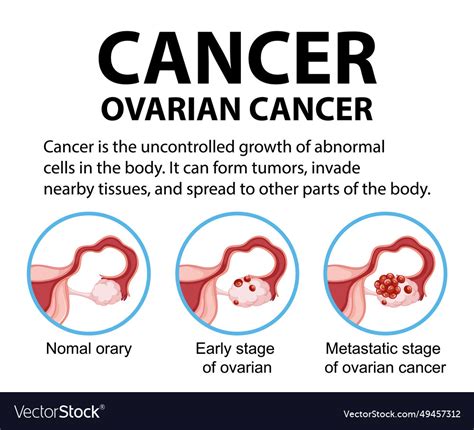 Woman ovarian cancer infographic stages and Vector Image