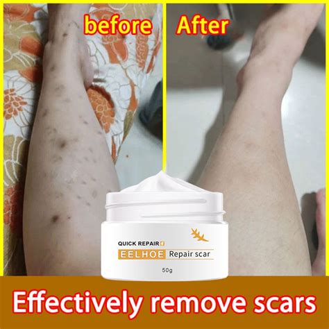 Old Scar Remover Gel Stretch Mark Removal Peklat Remover Scald Burns