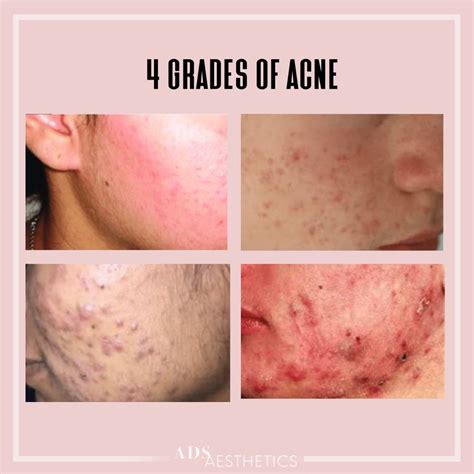 4 Grades Of Acne And How We Treat It My Skin Spot