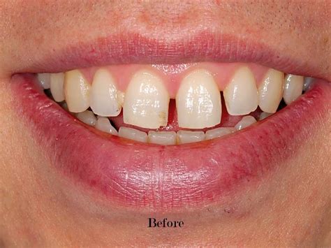 Veneers Before And After Gaps