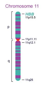 Genetic Cause - Sickle Cell Disease