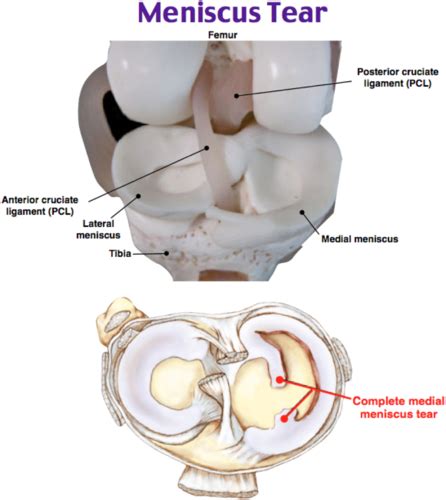 Knee Pathology Flashcards Quizlet