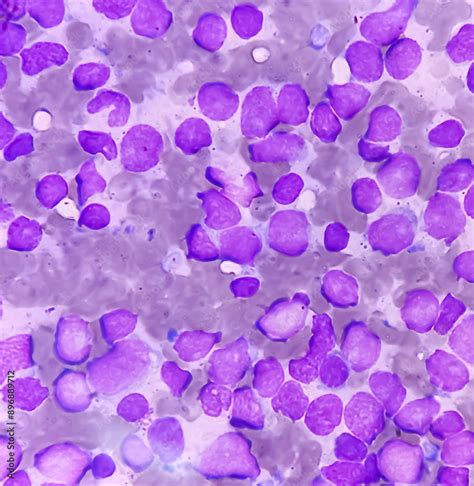 Bone Marrow Study Smear Picture Of Acute Myeloid Leukemia Blast Cell