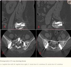 Sacrix Llc A Kicventures Company Published Study Showing Clinical And