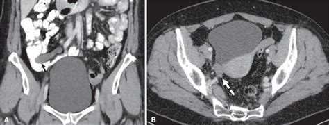 Scielo Brasil Mucocele Of The Appendix What To Expect Mucocele Of