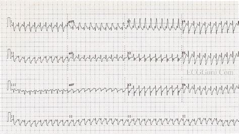 Atrial Flutter With 1:1 Conduction and Rate-dependent Right Bundle ...