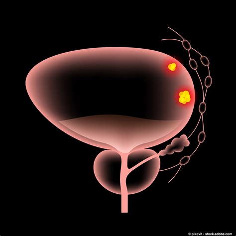 Cretostimogene Has Durable Response in BCG-Unresponsive Bladder Cancer