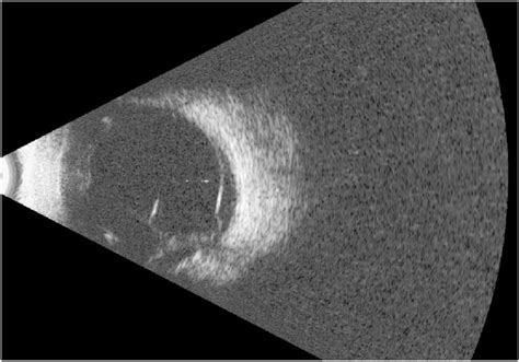 B Scan Ultrasound Image Of Right Eye Demonstrating Retinal Detachment