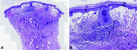 Photomicrographs of papillary dermal edema and mixed inflammation... | Download Scientific Diagram