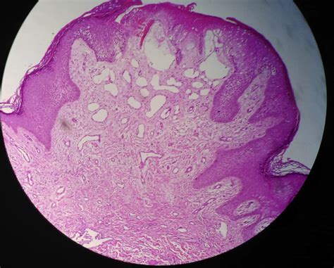 Skin Biopsy Showing Hyperkeratosis Irregular Epidermal Hyperplasia