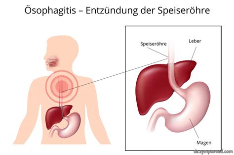 Ösophagitis Symptome