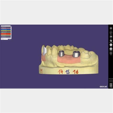 Exocad Implant Bundle Abacus Sistemi Cad Cam