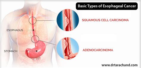 Esophageal Cancer Types Stages Symptoms Causes Diagnosis And Sexiz Pix