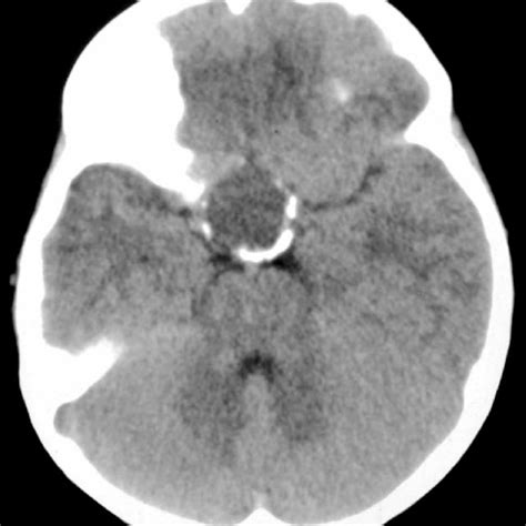 Magnetic Resonance Image Showing A Cystic Sellar Suprasellar Mass