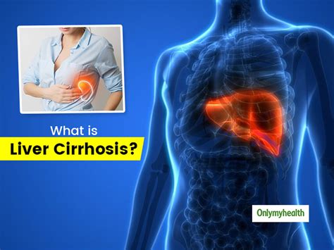 Liver Cirrhosis Causes