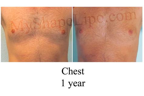 Myshape Lipo Announces New Minimally Invasive Laser Liposuction