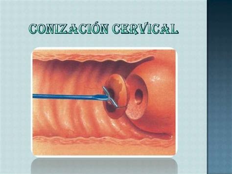 Cirugias Ginecologicas