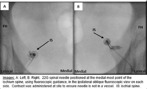 Figure 1 From Fluoroscopy Guided Transgluteal Pudendal Nerve Block For