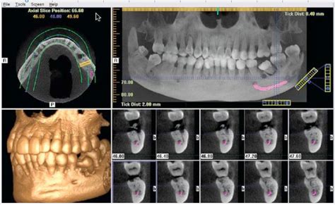 Ct Scanner Comprehensive Implant Planning El Paso Tx