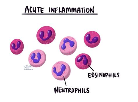 Acute Inflammation MyPathologyReport Ca