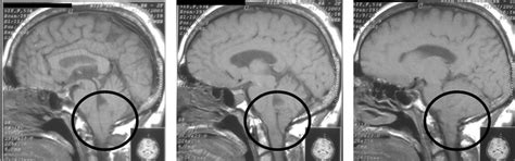 Arnold Chiari Malformation Type I In 52 Years Old Female Patient