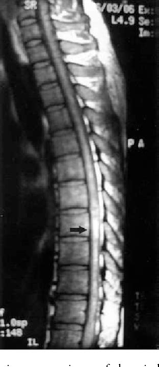 Figure 1 From Spinal Intramedullary Cavernous Hemangioma Semantic