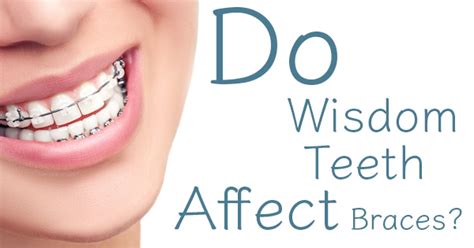 How Long Does It Take A Dentist To Remove Braces Dental Braces