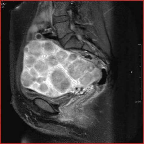 John Libbey Eurotext Sang Thrombose Vaisseaux Traitement Du Fibrome