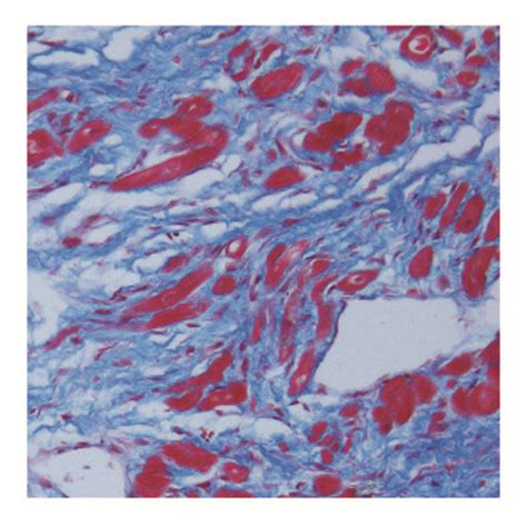 Masson Trichrome Staining Of The Infarcted Zone On Day 28 After Ang 1