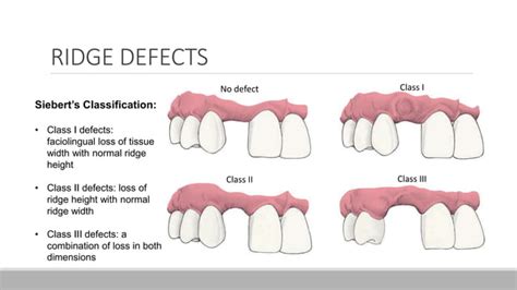 COMPONENTS OF FIXED PARTIAL DENTURE | PPT