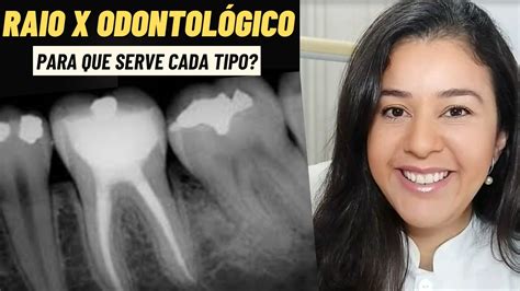 Raio X Odontol Gico Para Que Seu Dentista Pede Cada Tipo De