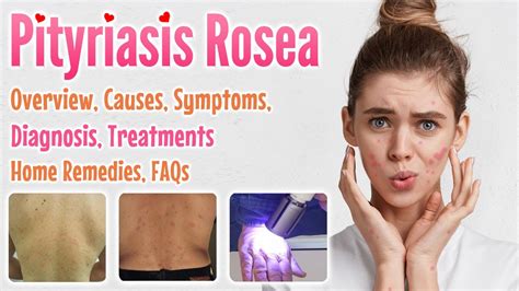 Pityriasis Rosea Overview Causes Signs And Symptoms Diagnosis