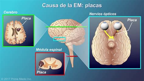 Explicaci N De La Esclerosis M Ltiple Youtube