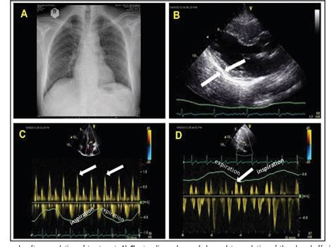 Figure From Complete Resolution Of Constrictive Pericarditis After