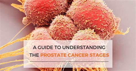 Prostate Cancer: Understanding the Stages | Sri Ramakrishna Hospital