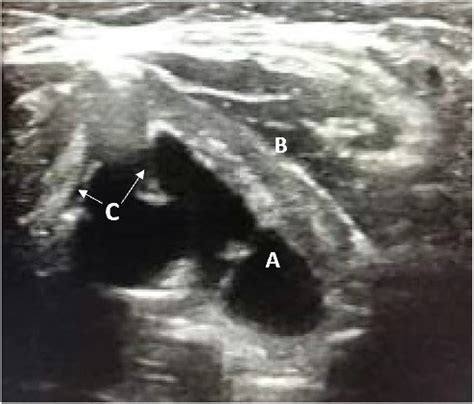 Oncocytic Papillary Cystadenoma Of The Larynx A Rare And Masquerading