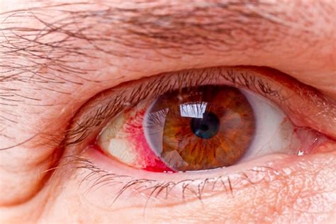 Glaucoma é hereditário CEOOT Fisioterapia