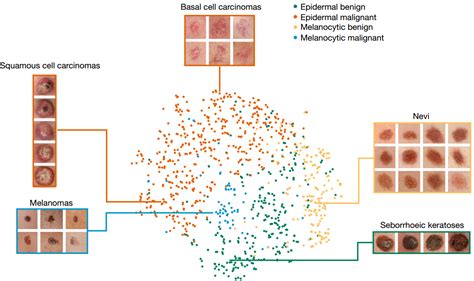 Deep Learning Algorithm Diagnoses Skin Cancer As Well As Seasoned