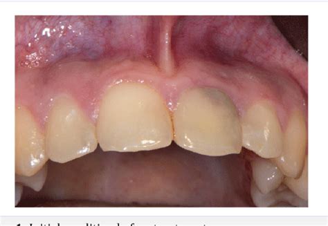 Figure From Implant Rehabilitation Of Internal Root Resorption After