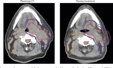 Radiation Therapy Neck All About Radiation