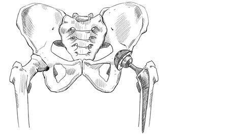 Biomet Hip Replacement Lawsuits | McIntyre Law