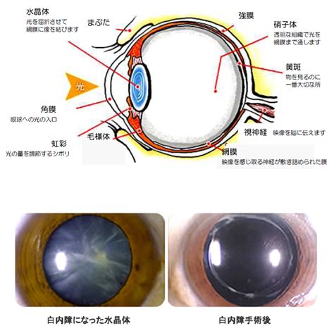 白内障手術を受けられる方へ 市立大津市民病院