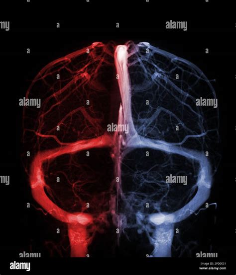 Cerebral Venograpgy For Diagnosisi Cerebral Venous Thrombosis Stock