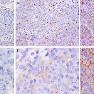 Representative PD L1 Expression In Thymic Epithelial Tumors The PD L1